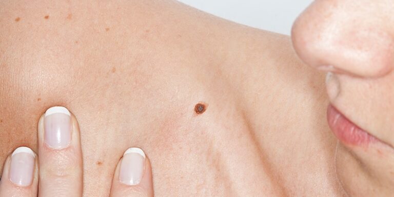 mole check on shoulder